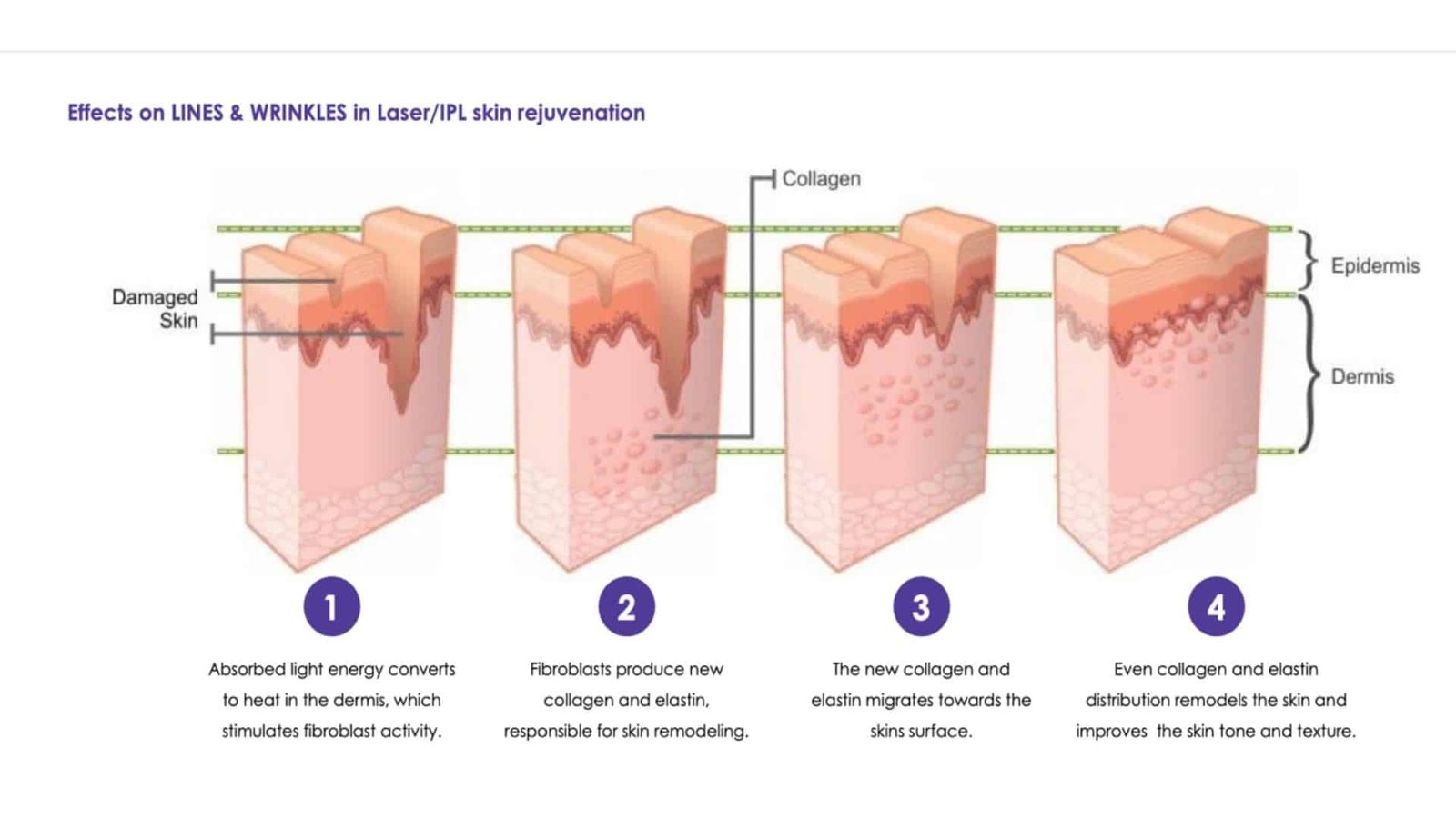 Laser Skin Resurfacing
