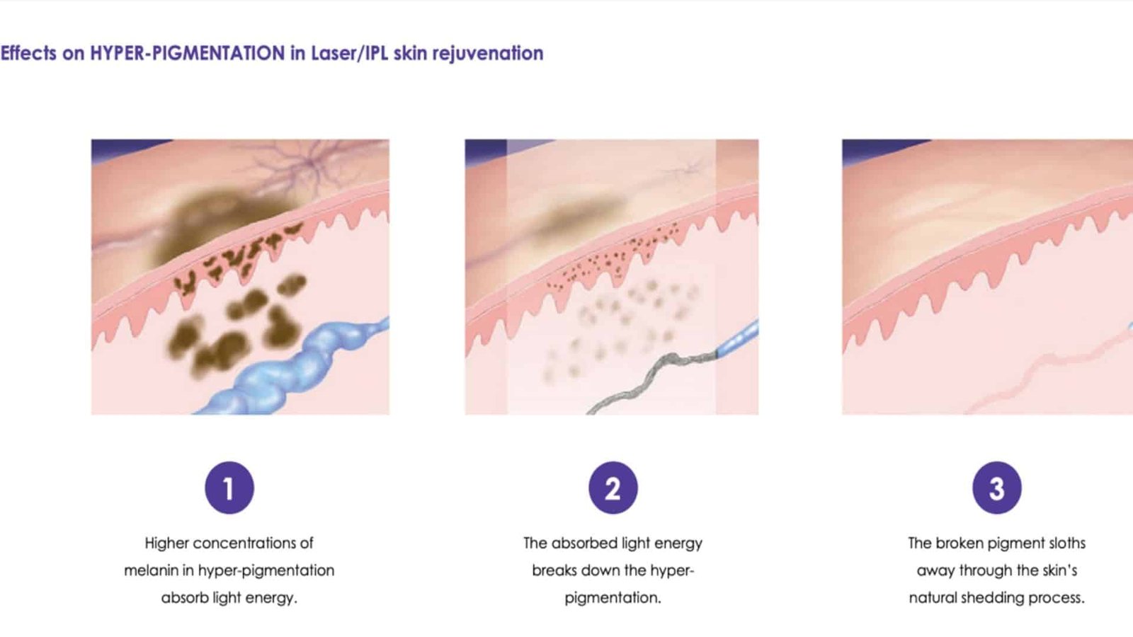 Laser Skin Resurfacing